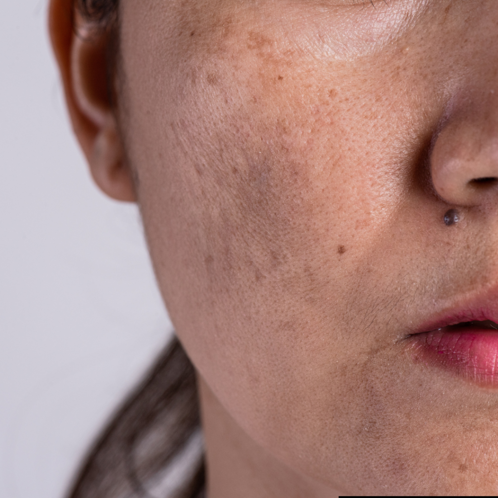 Melasma on a women face