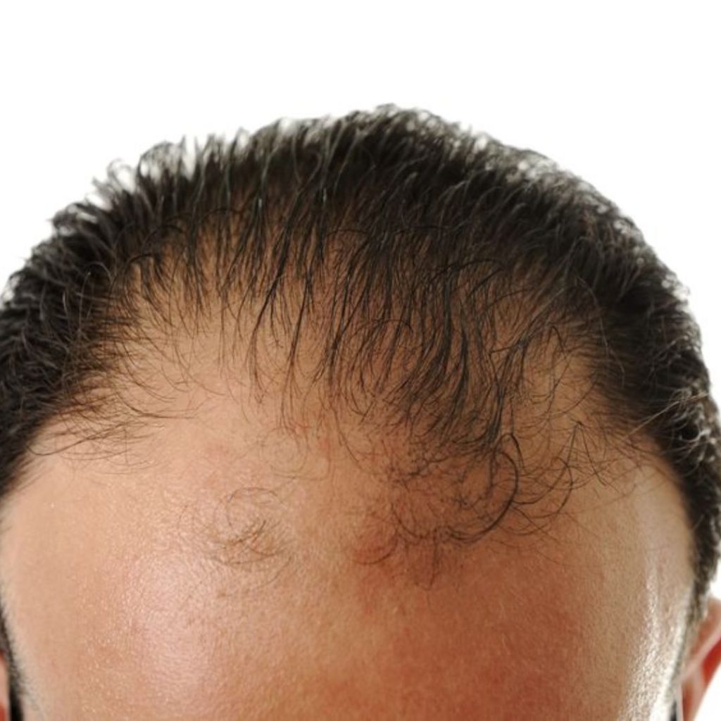 a man with no hair and taking a Hair PRP treatments at facelit