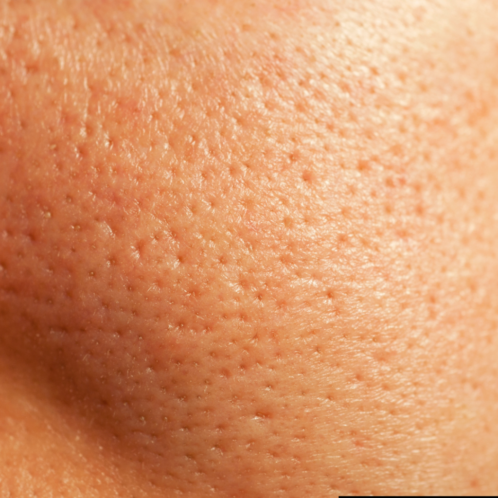 Enlarged pores on a women face