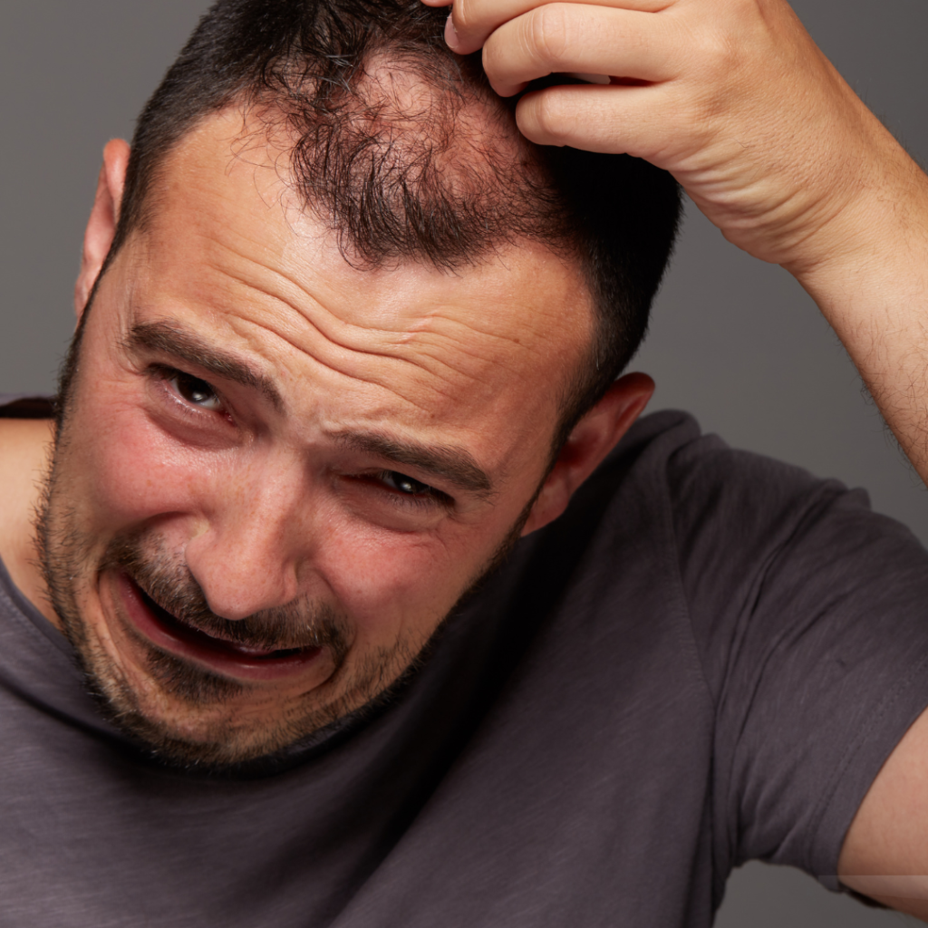 A man with Androgenetic Alopecia taking aHair PRP treatment at facelit best hair clinic in bangalore