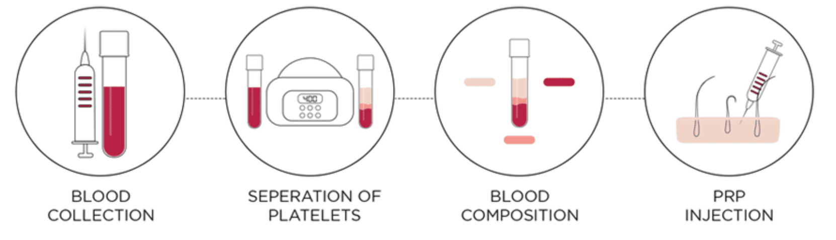 Best PRP Clinic in Trivandrum process of prp treatment at facelit