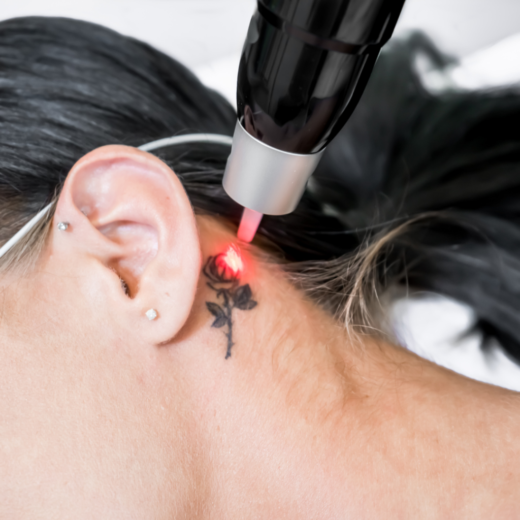 tattoo removal on women face