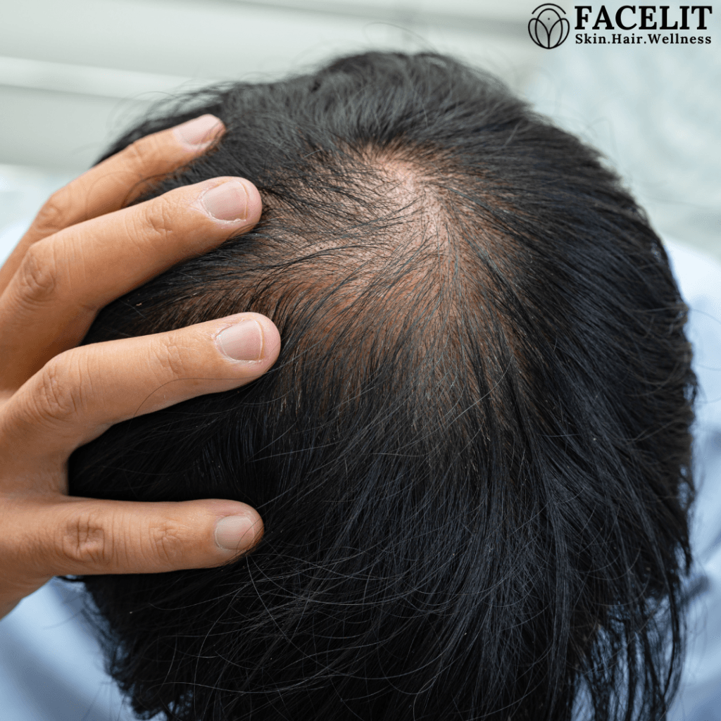 Best Hair Clinic in Trivandrum