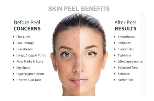 Best Chemical Peel in Bangalore before and after results