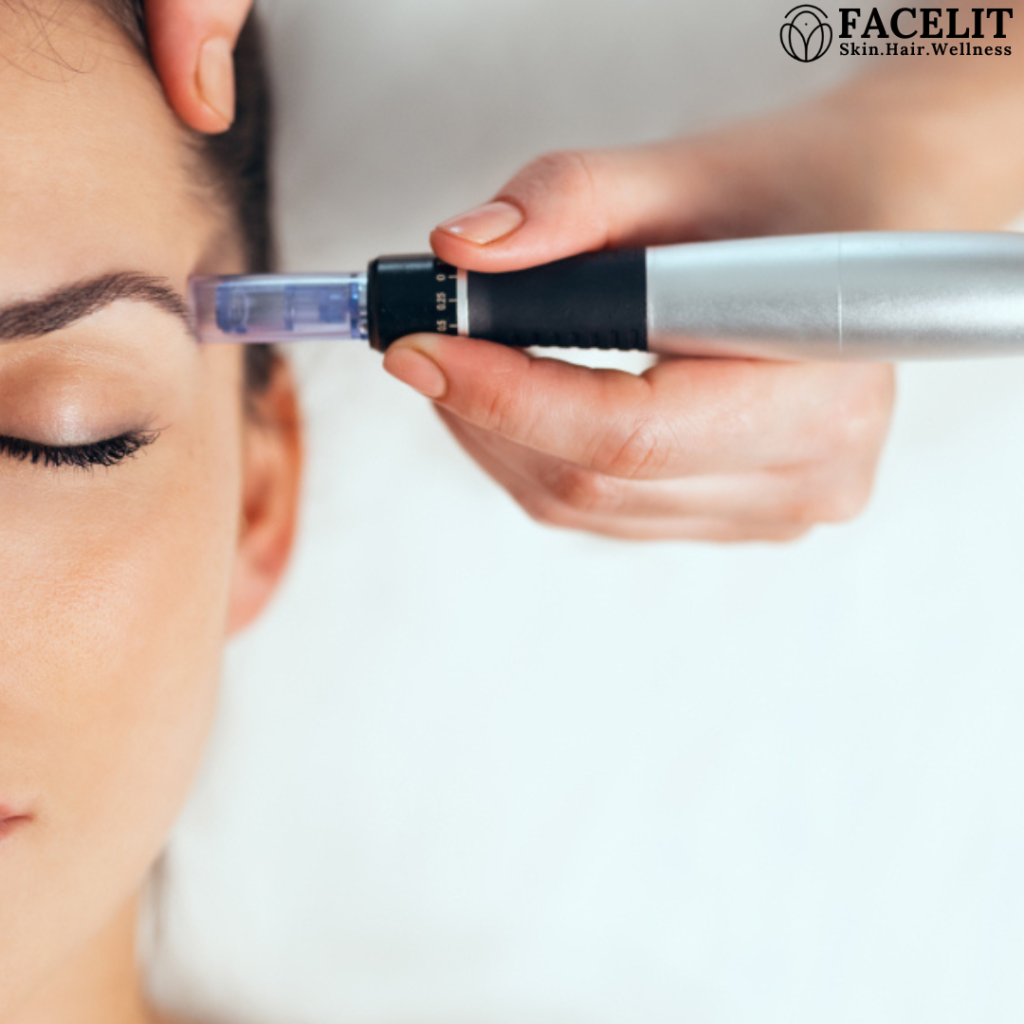 Microneedling before and after results at Facelit Clinic