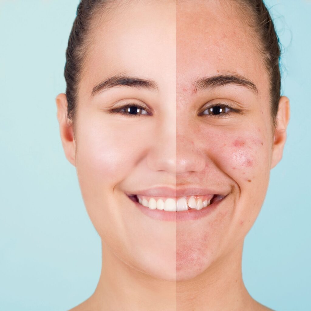 Microneedling Before and After Results taken by women for Acne Scars treatment at facelit