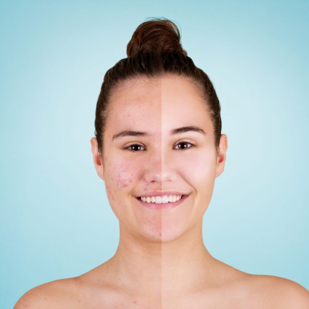 chemical peel before and after results at facelit clinic