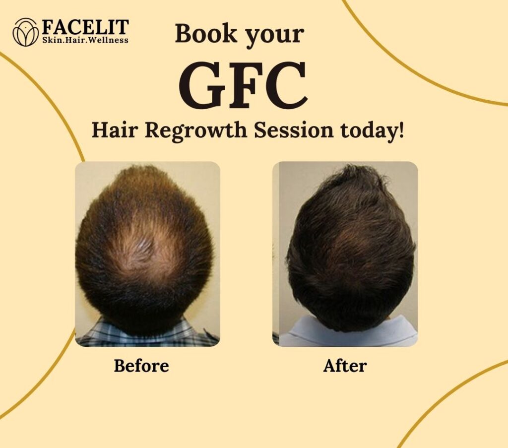 cost of GFC hair treatment in Jayanagar