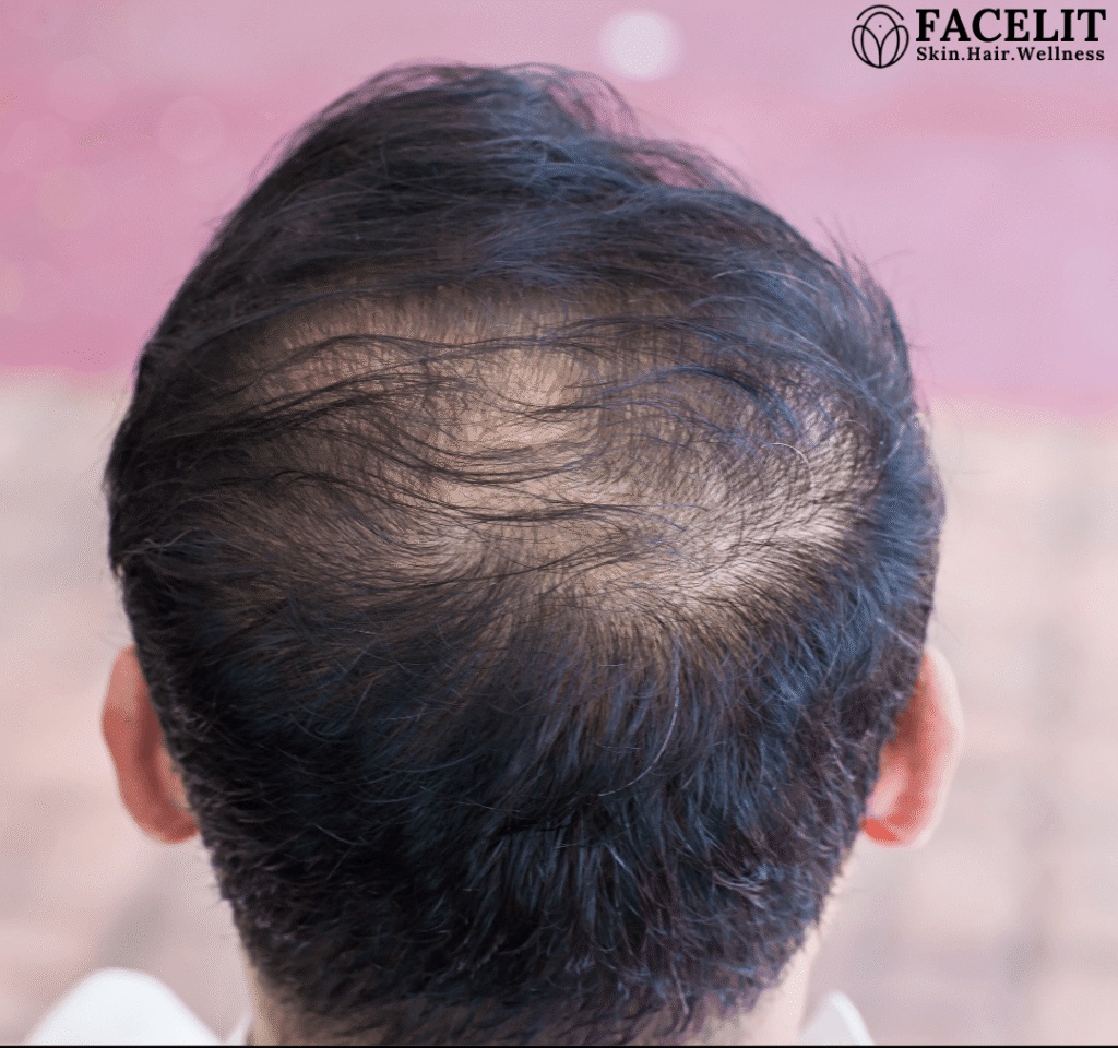 Can PRP Reverse Hair Thinning in Men