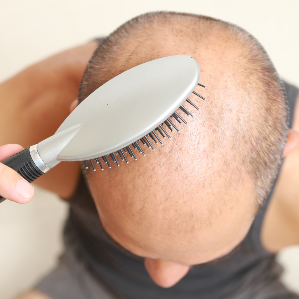 Can PRP Reverse Hair Thinning in Men?