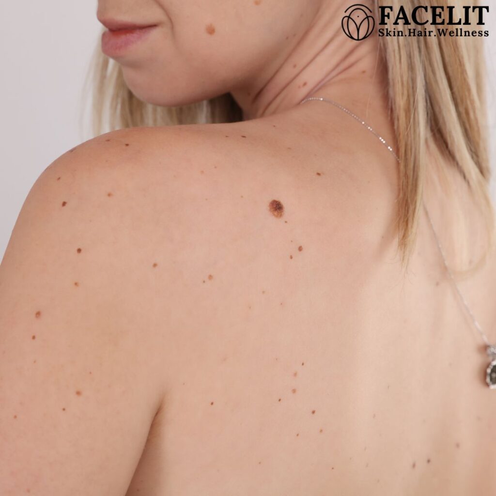 skin tag