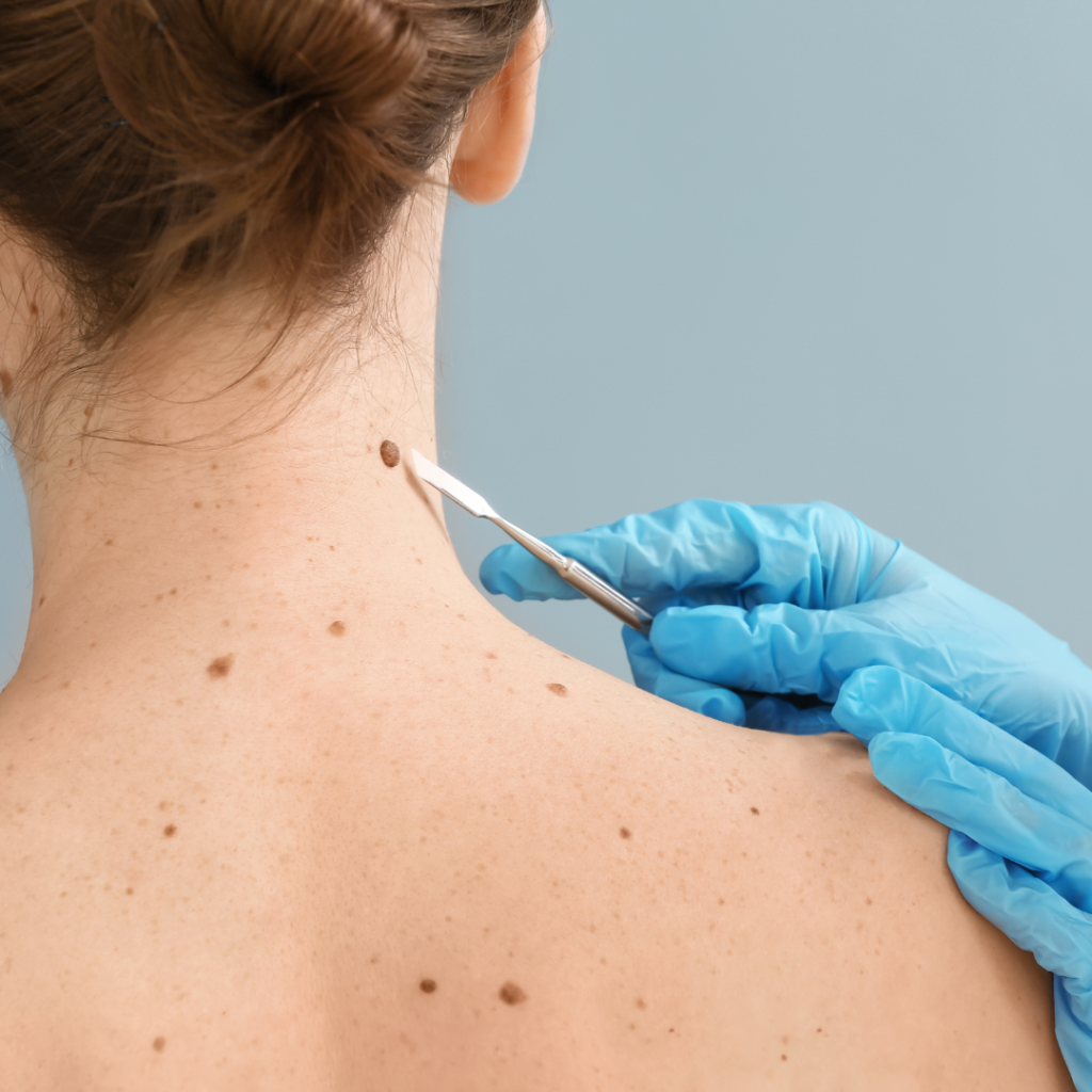 Skin Tag and Tan Removal in Bangalore