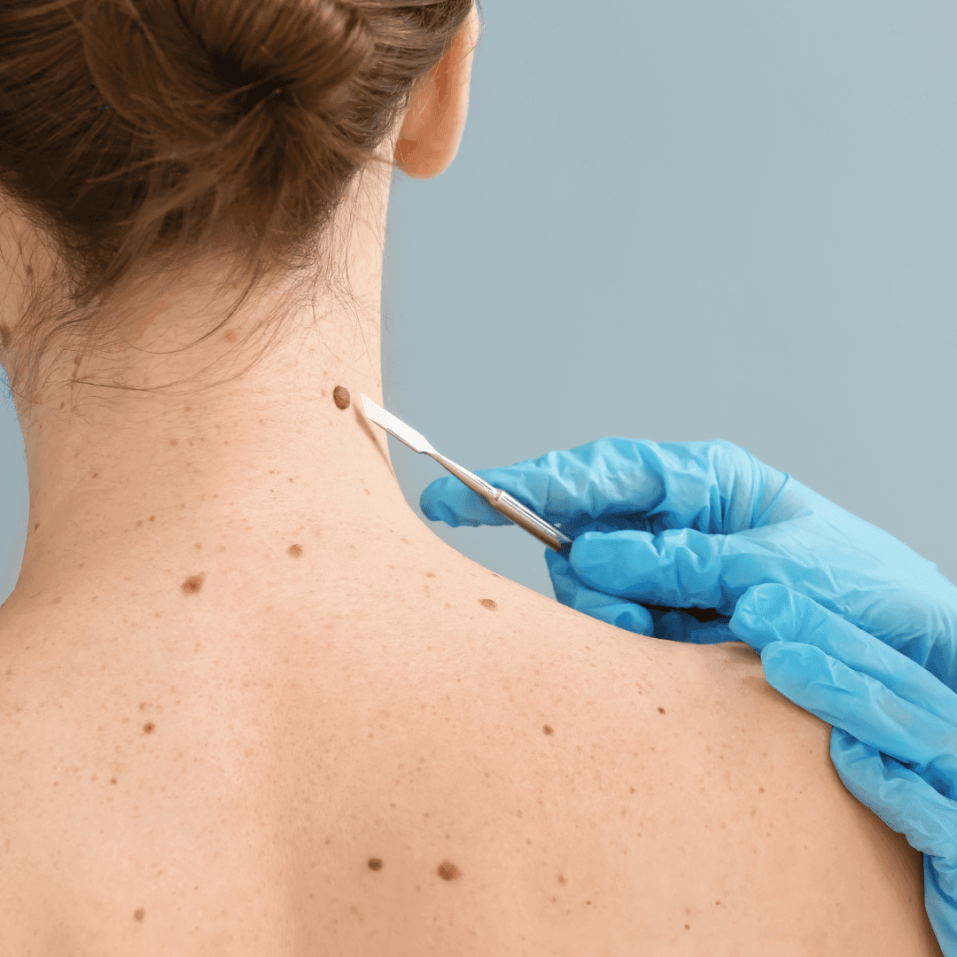 Skin Tag and Tan Removal in Bangalore: A Clear Path to Glowing, Healthy Skin