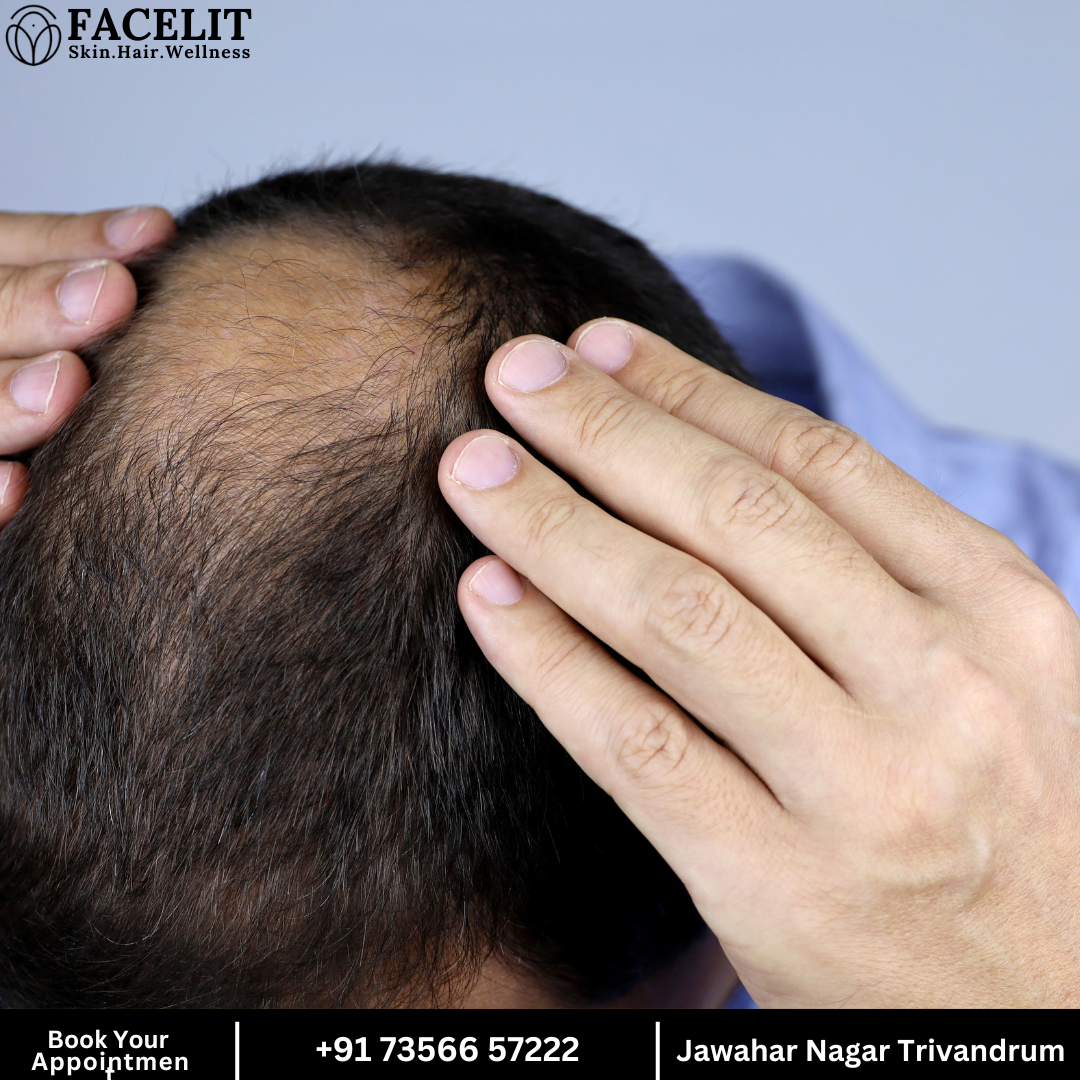 Hair Treatment in Trivandrum