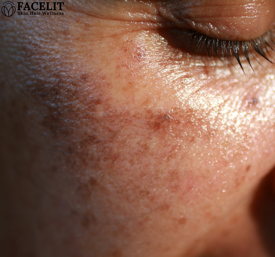 How to Treat Dark Spots on the Face