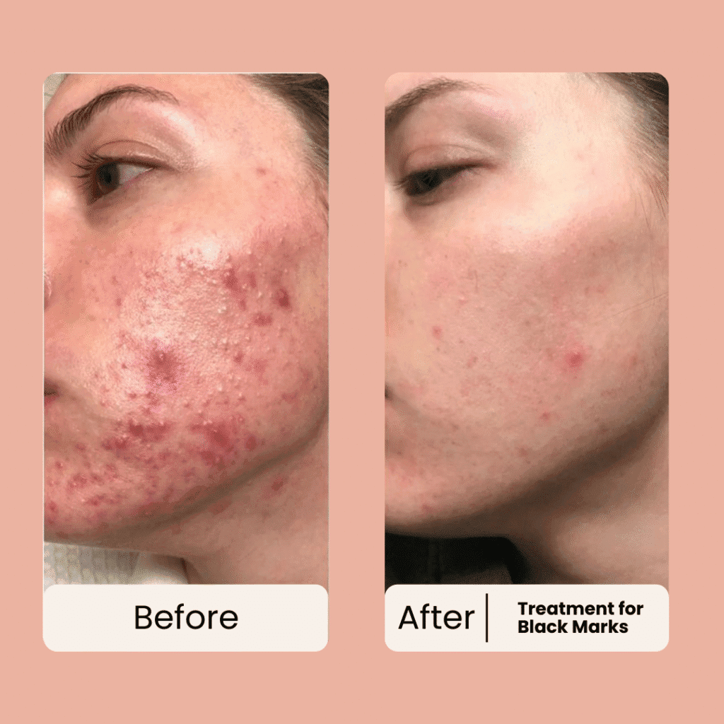 acne and black marks treatment done at facelit clinic