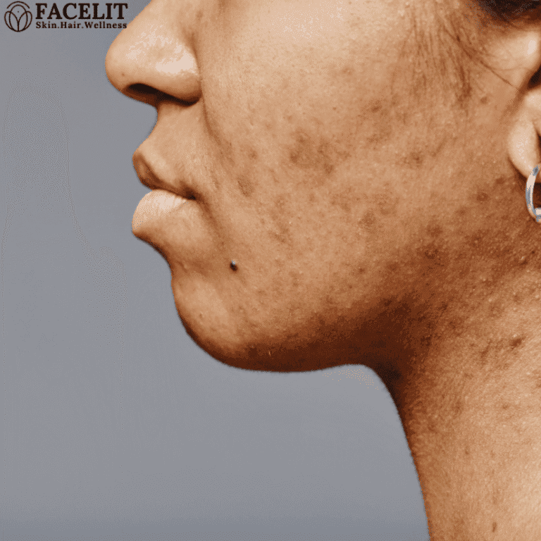 How to Remove Black Marks on Face Quickly