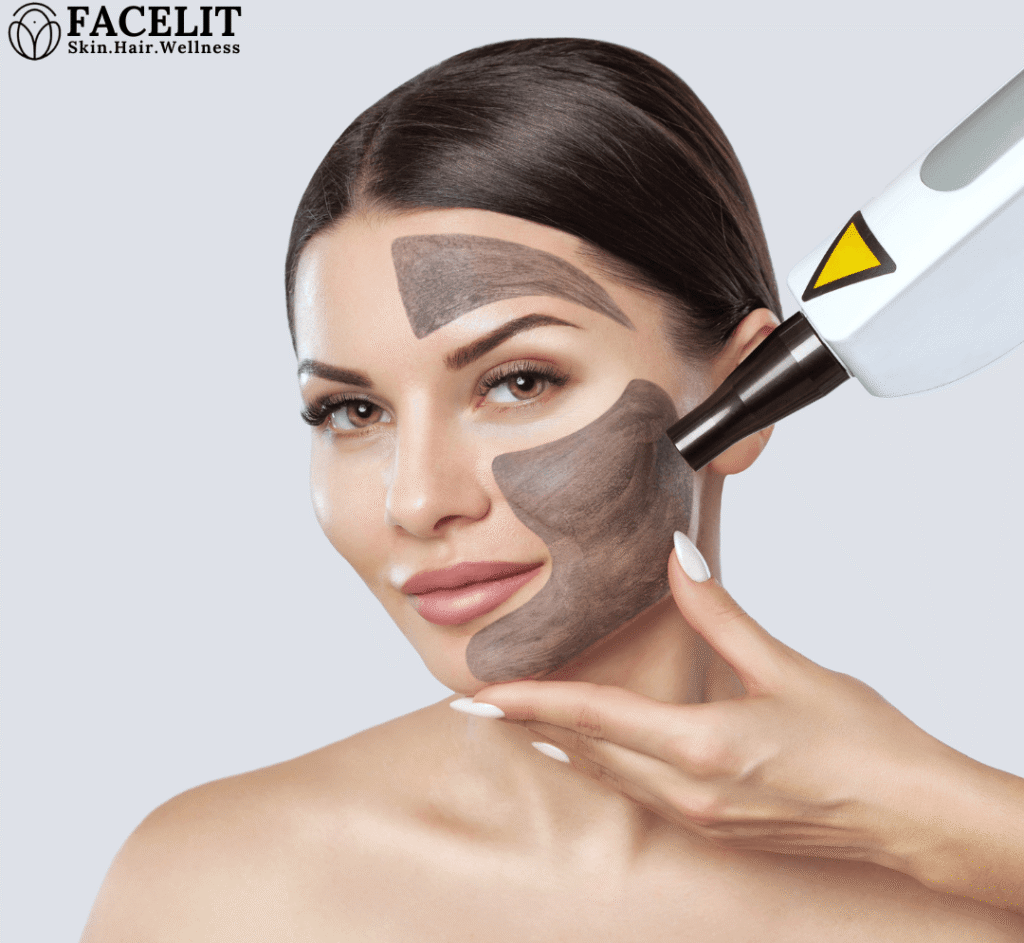 Best Laser Treatment for Deep Acne Scars