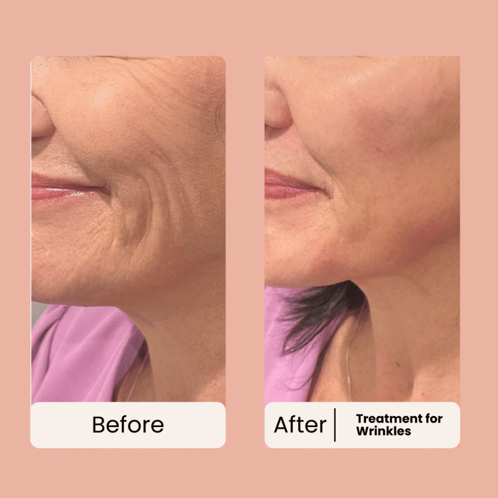 before and after for forehead wrinkles