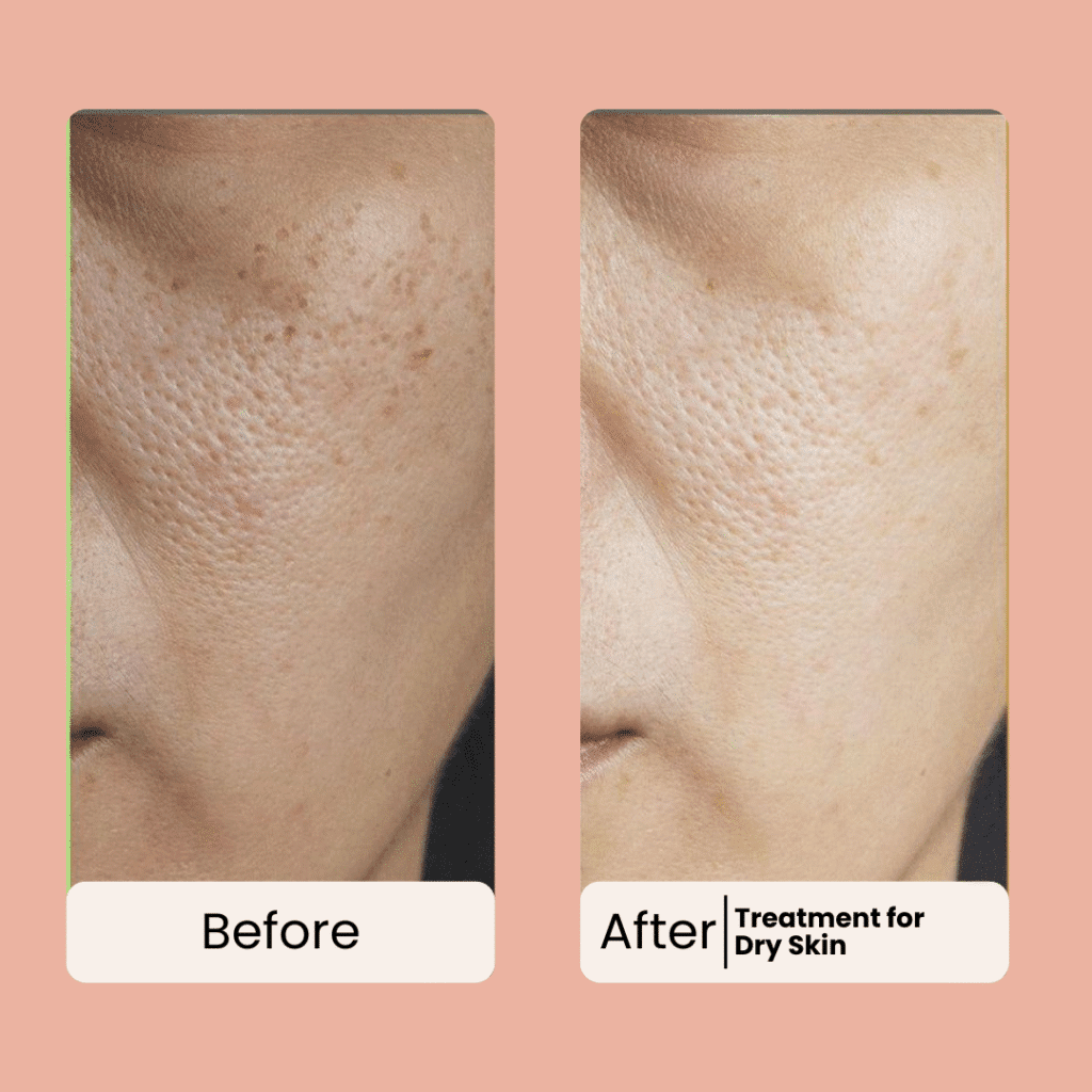 dry skin treatment before and after