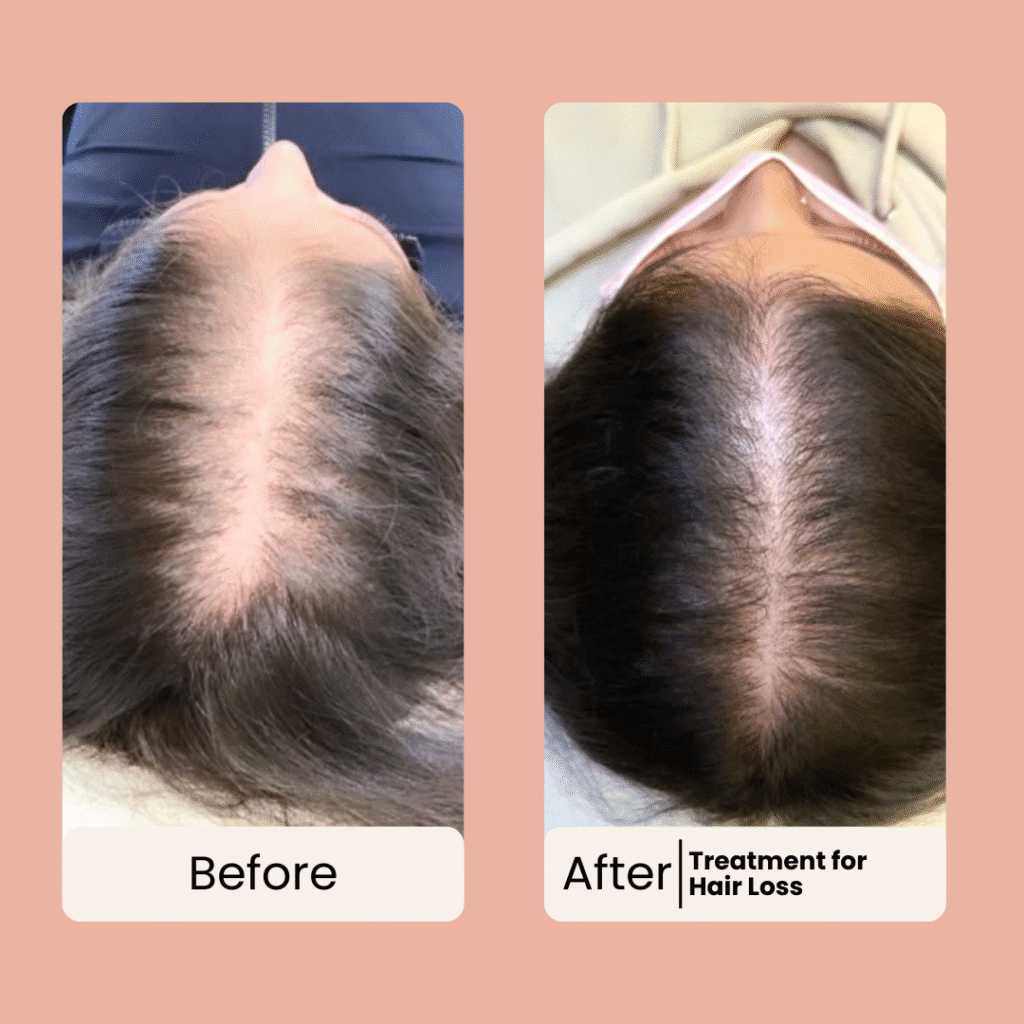 best hair loss treatment give at facelit clinic before and after
