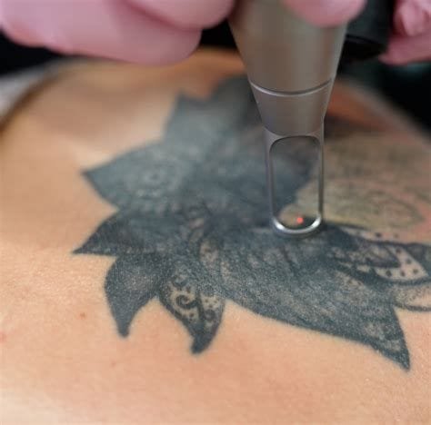 Permanent Tattoo Removal