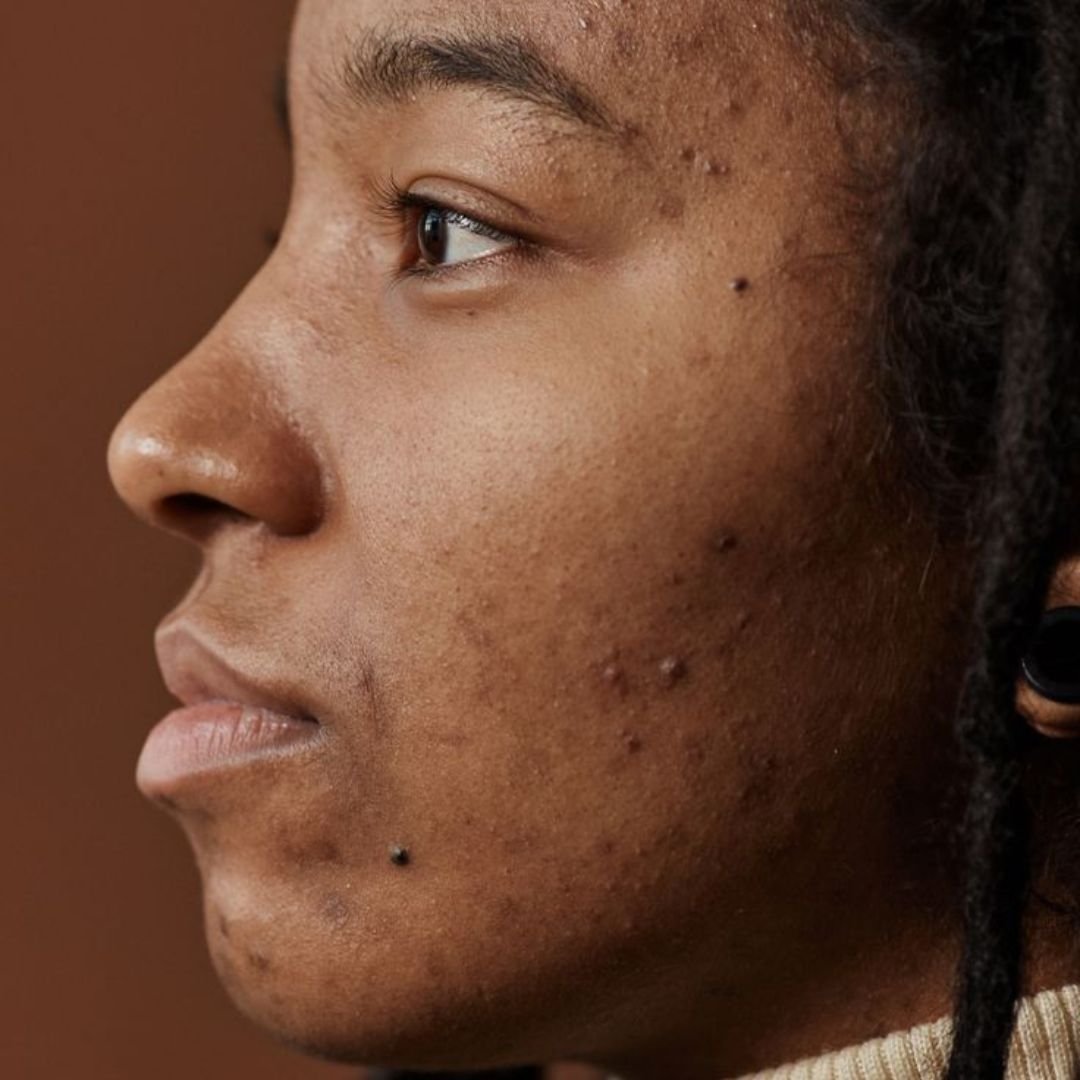 How to Fade Acne Scars on Dark Skin