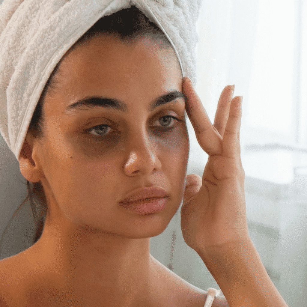 Dark Circles Causes Best Treatments in Trivandrum