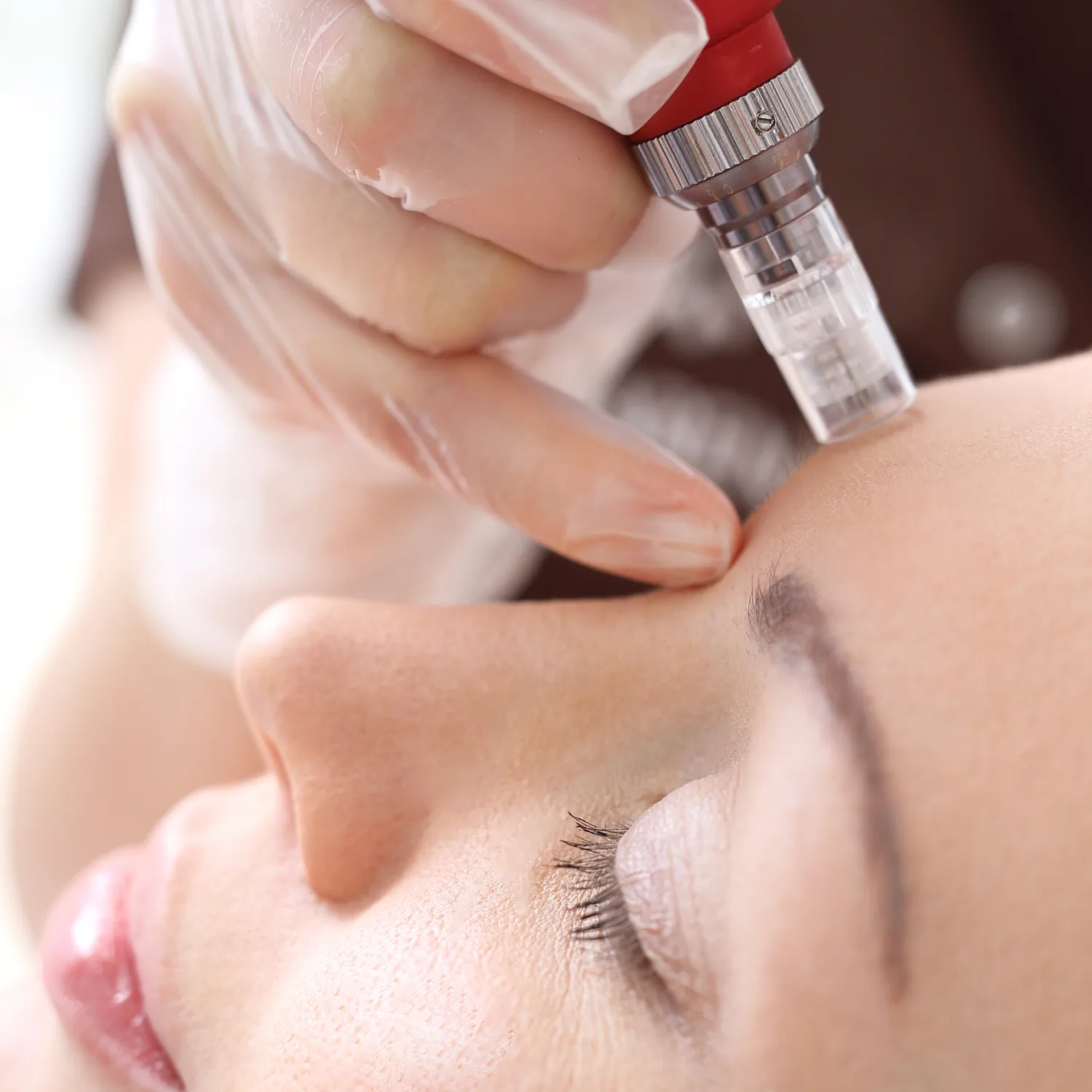 How Does Microneedling Help Rejuvenate and Brighten the Skin