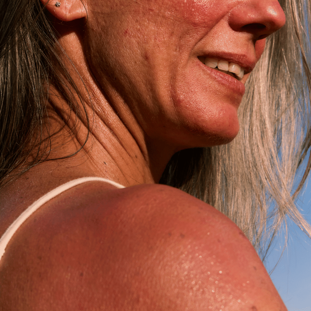 Skin Treatments For Sun Damage in Bengaluru