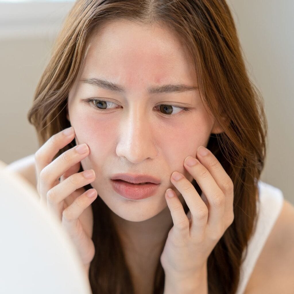 Acne Scar Treatment for Sensitive Skin