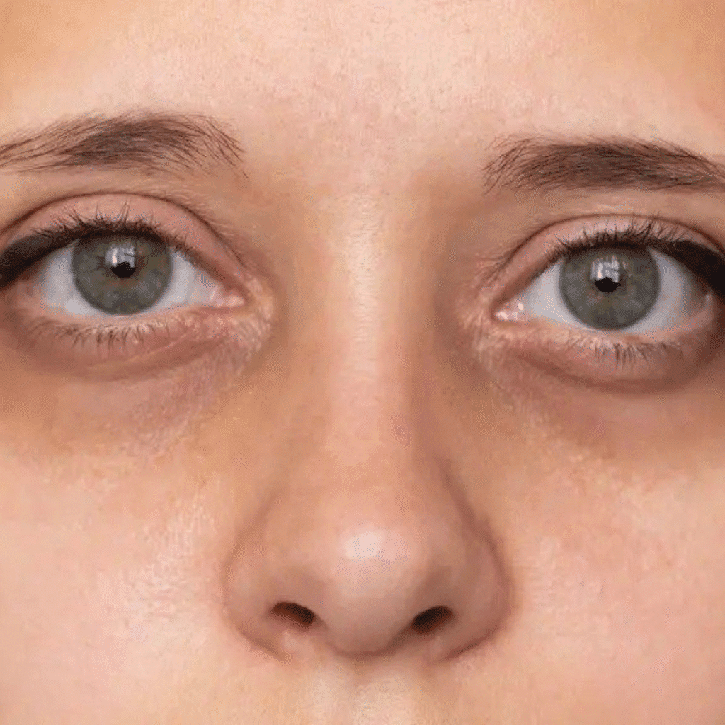 Under Eye Dark Circles Treatment in Karunagappally