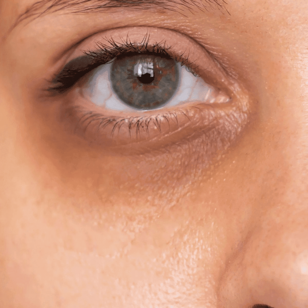Under Eye Dark Circles Treatment in Karunagappally