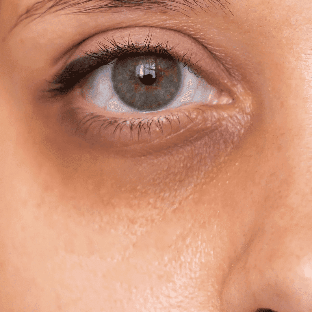 Under Eye Dark Circles Treatment in Karunagappally