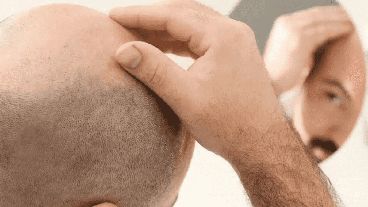 Hair Loss Treatments For Men | Effective Solutions to Stop Hair Fall
