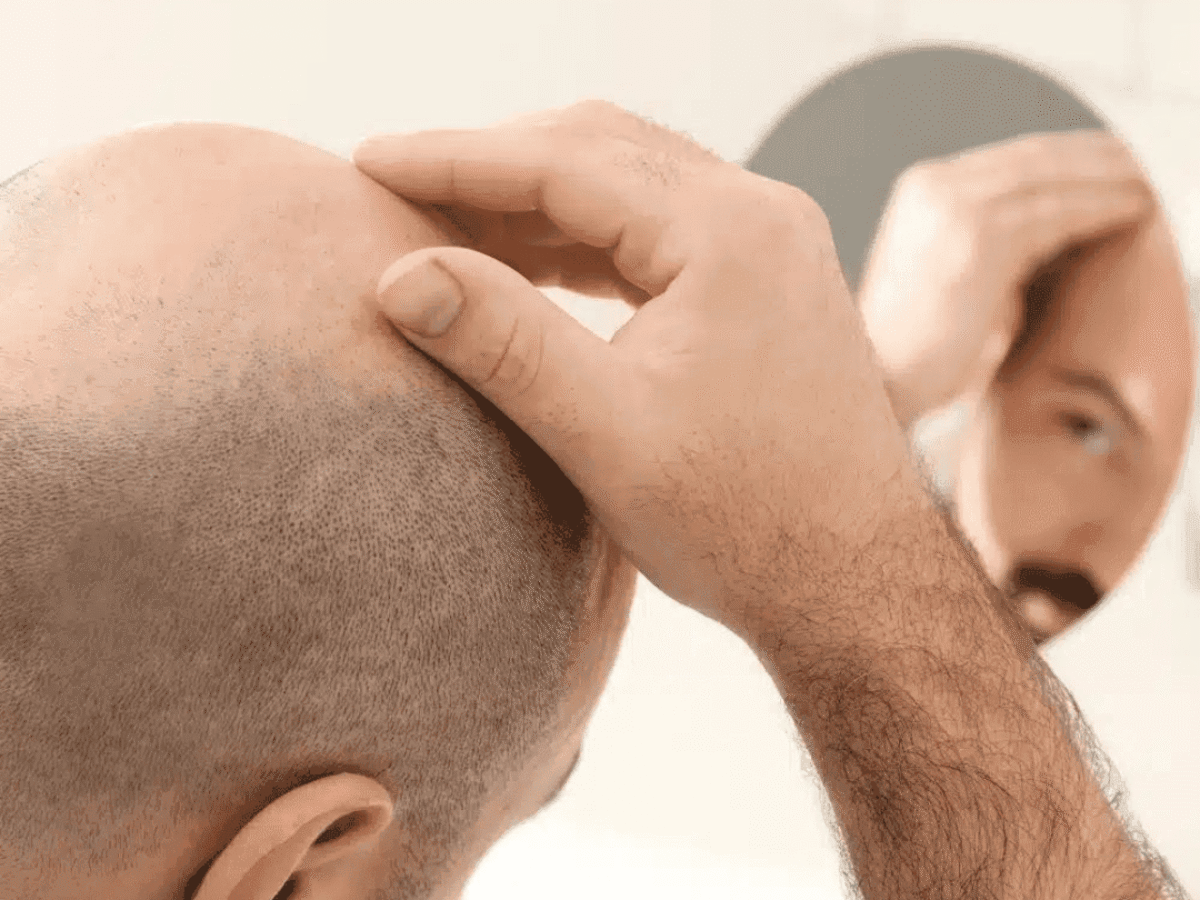 Hair Loss Treatments For Men | Effective Solutions to Stop Hair Fall