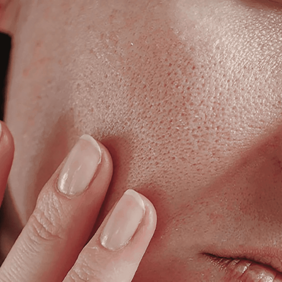Open Pores Treatment in Trivandrum