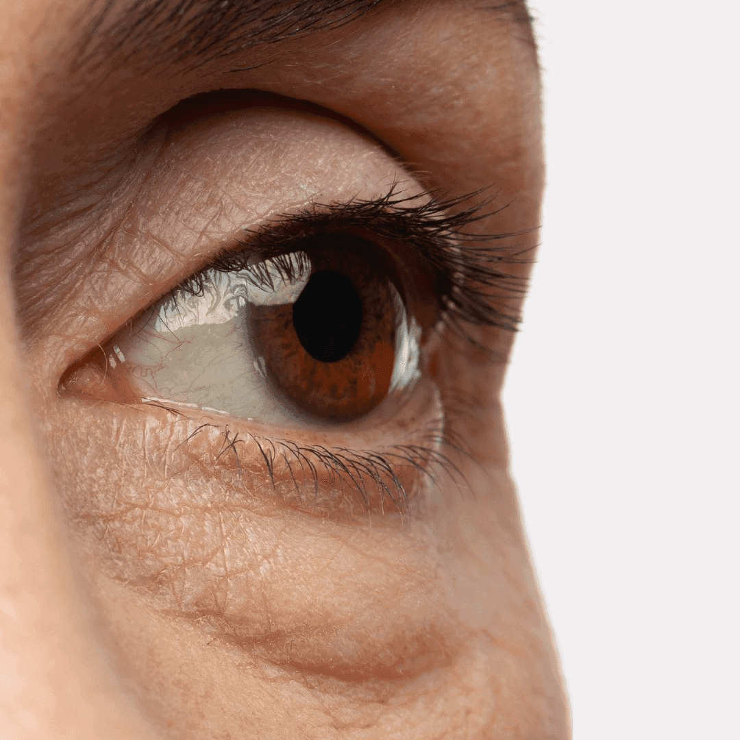 How to Get Rid of Under Eye Bags? 7 Proven Ways