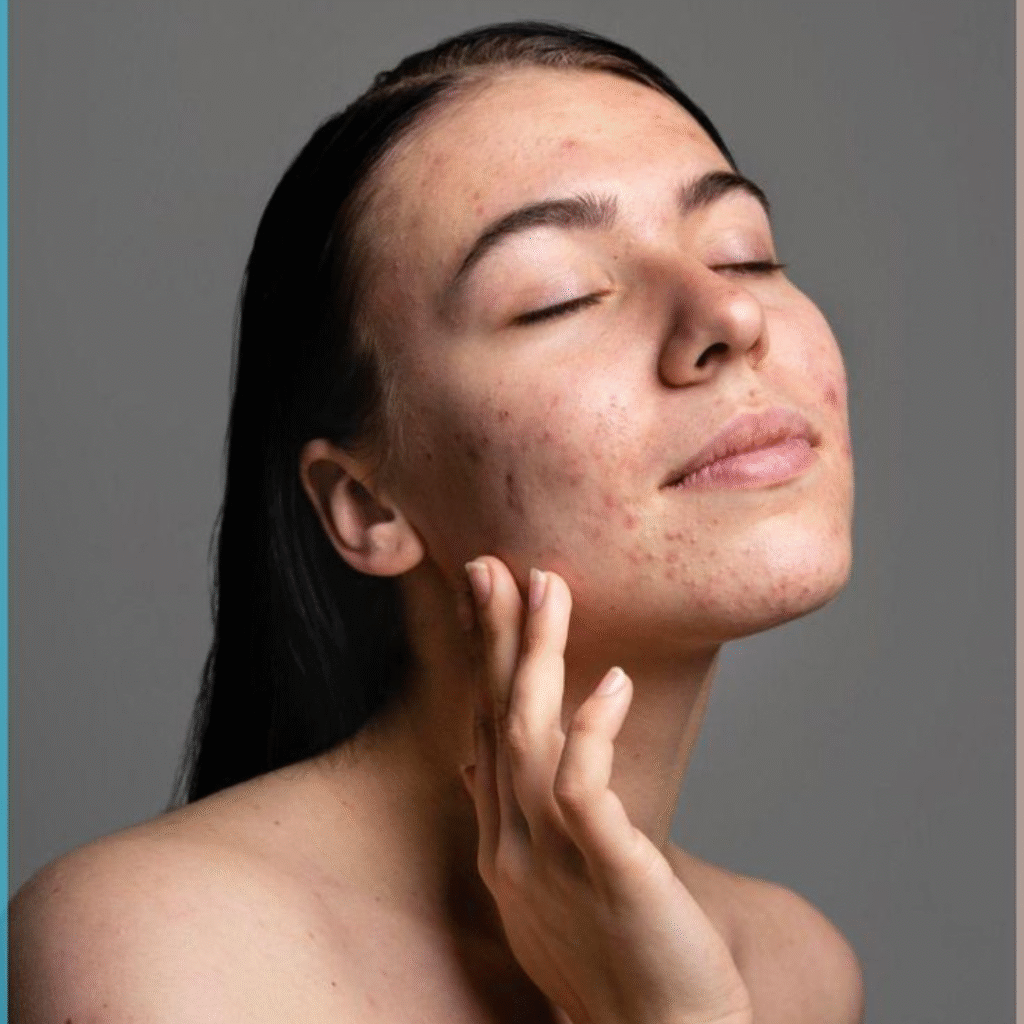 How to get rid of pimple marks from face - Facelit Clinic treatment