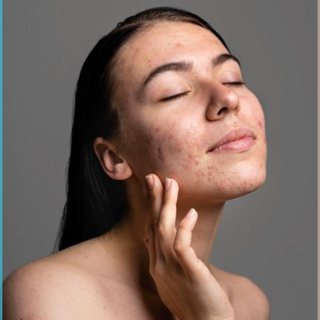 How to get rid of pimple marks from face - Facelit Clinic treatment