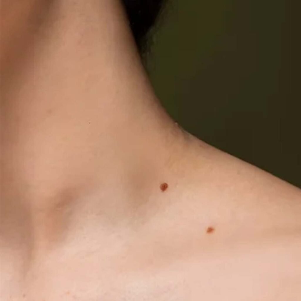Mole & Skin Tag Removal