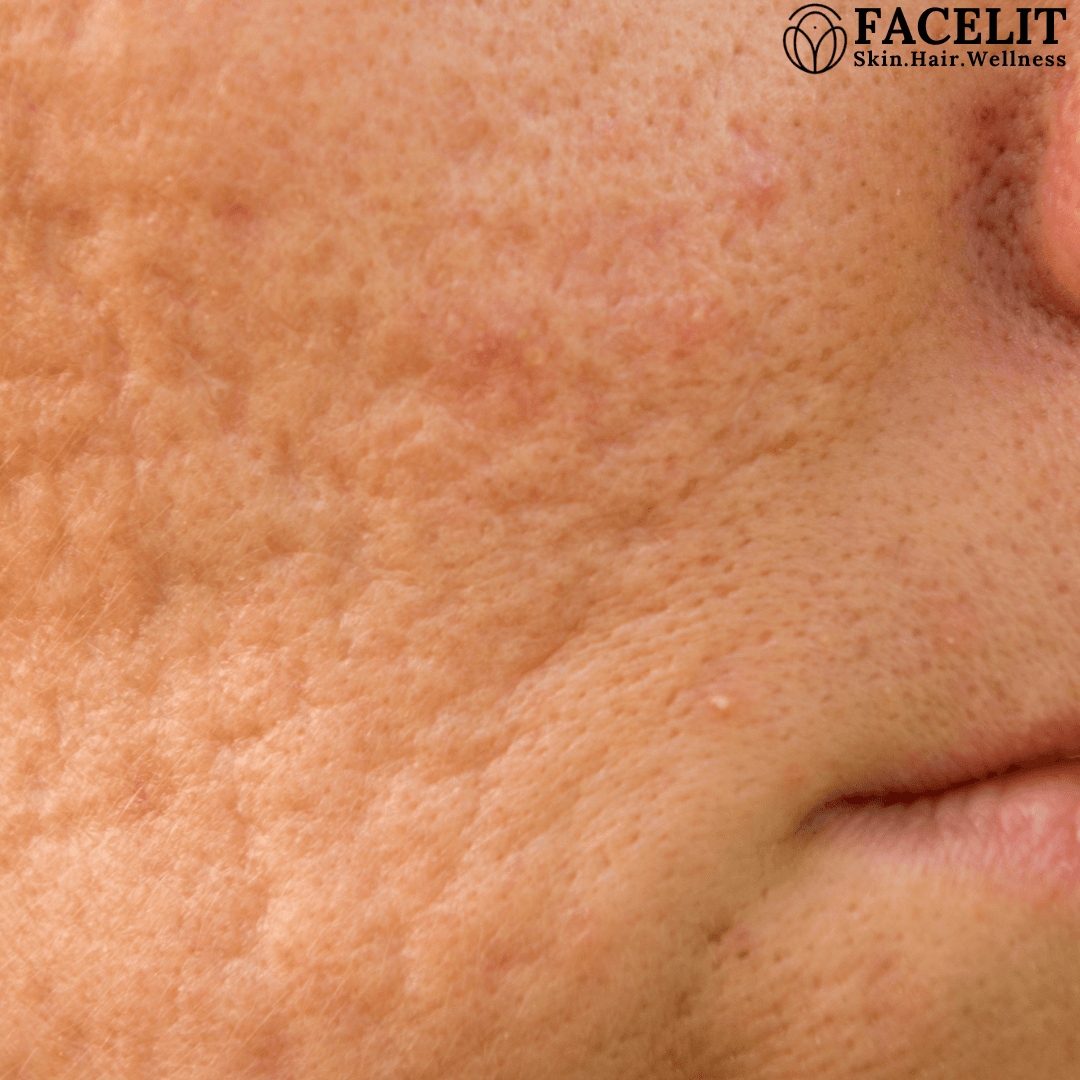 How to Get Rid of Large Pores and How to Treat Them