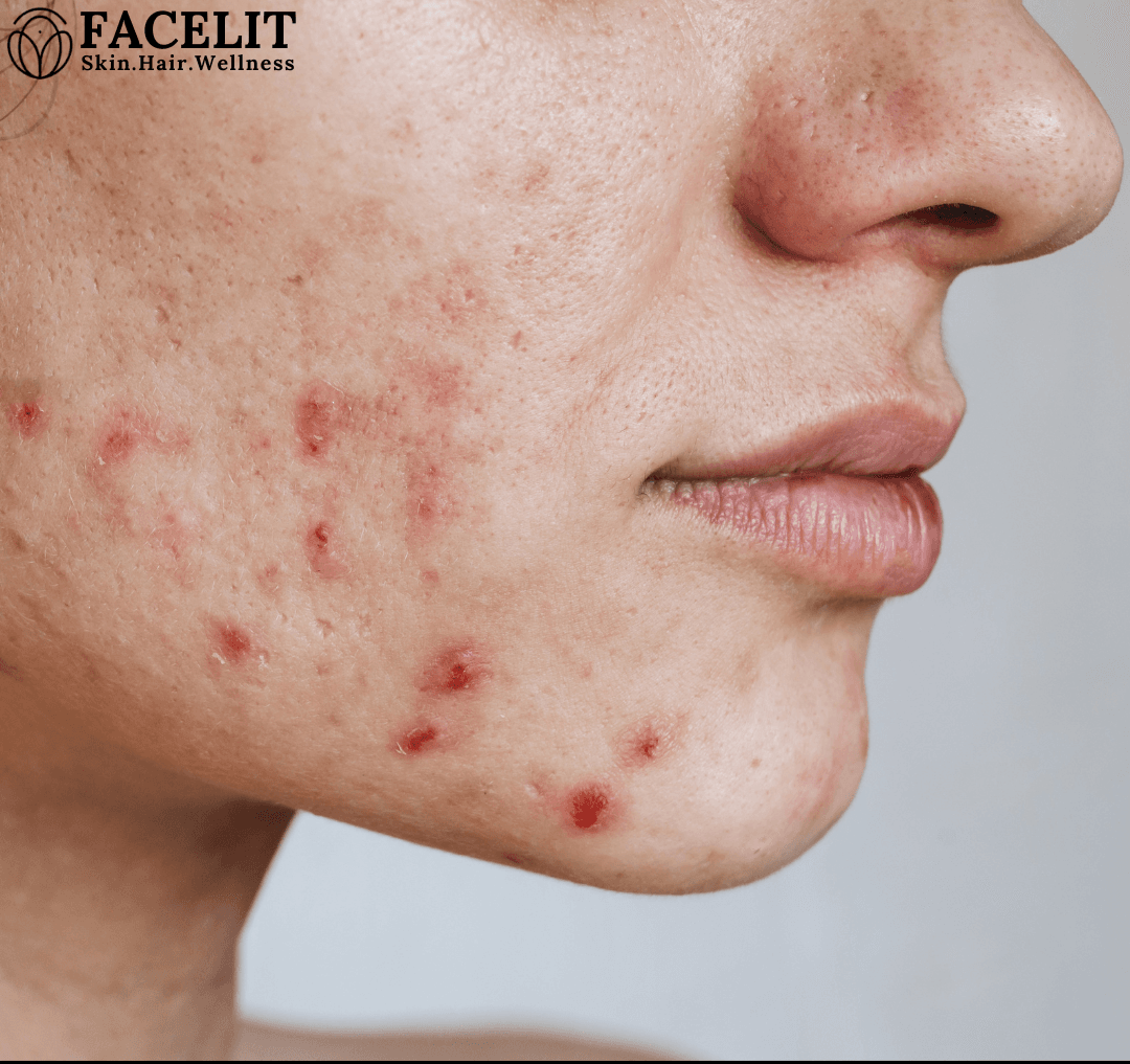 how to reduce dark pimple spots on face