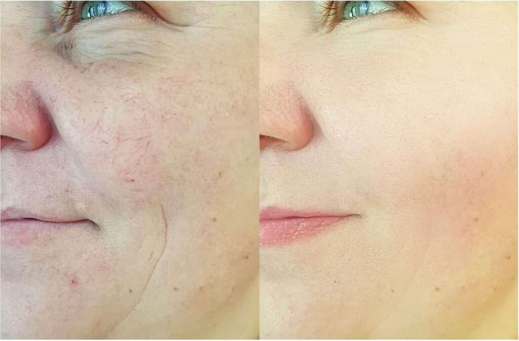 Microneedling Before and After Results taken by women for Fine Lines and Wrinkles treatment at facelit