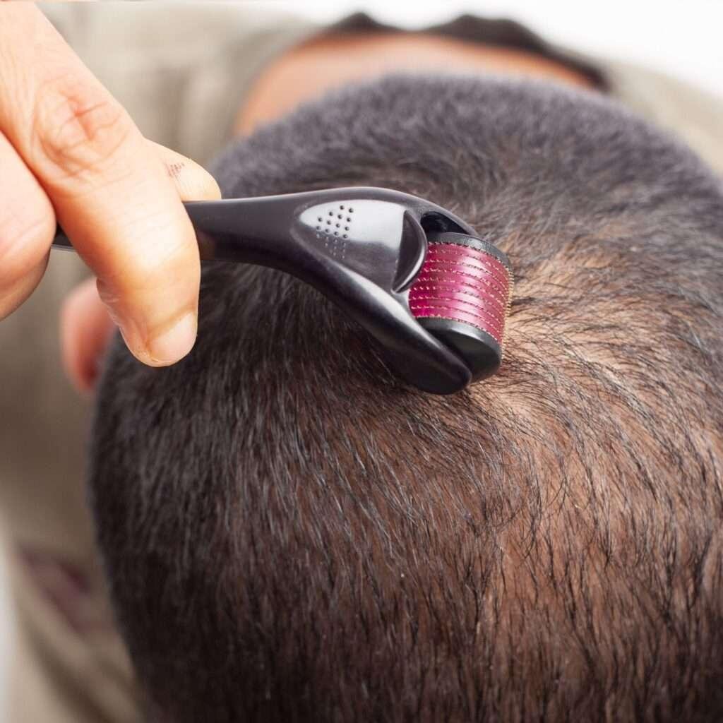 Microneedling Before and After Results taken by men for Hair Loss treatment at facelit