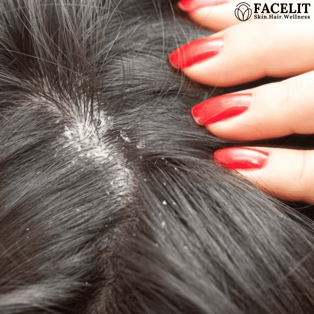dandruff treatment done at facelit clinic