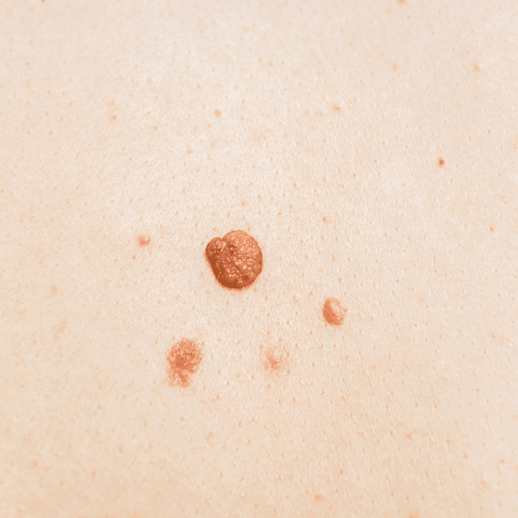Skin Tag and Tan Removal in Bangalore done at facelit clinic