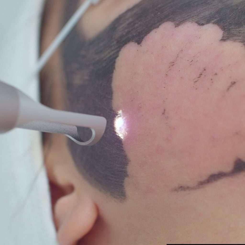 co2 laser-treatments