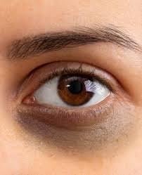 Dark Circles Causes Best Treatments in Trivandrum