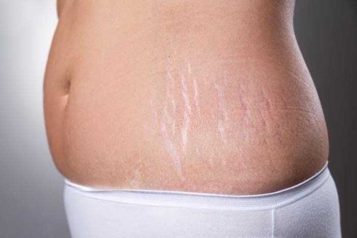 How Can You Reduce Stretch Marks